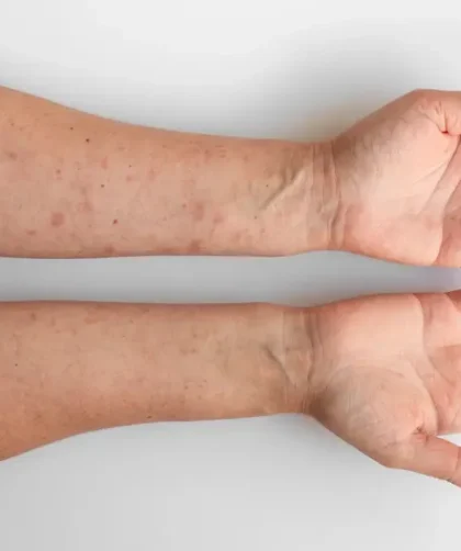 Ciri Penyakit Campak